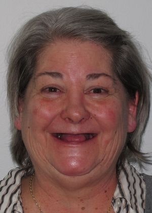 Staten Island Aesthetic & Implant Dentist patient with no teeth