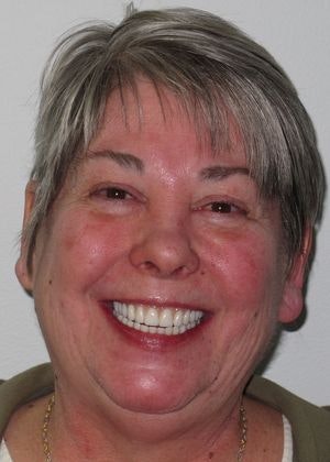 Staten Island Aesthetic & Implant Dentist patient after dental implants