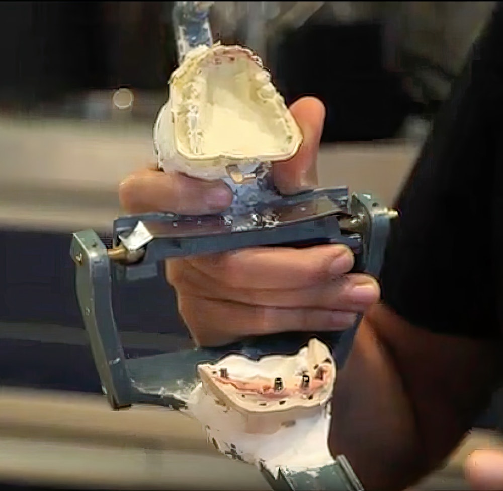 Dental implant model