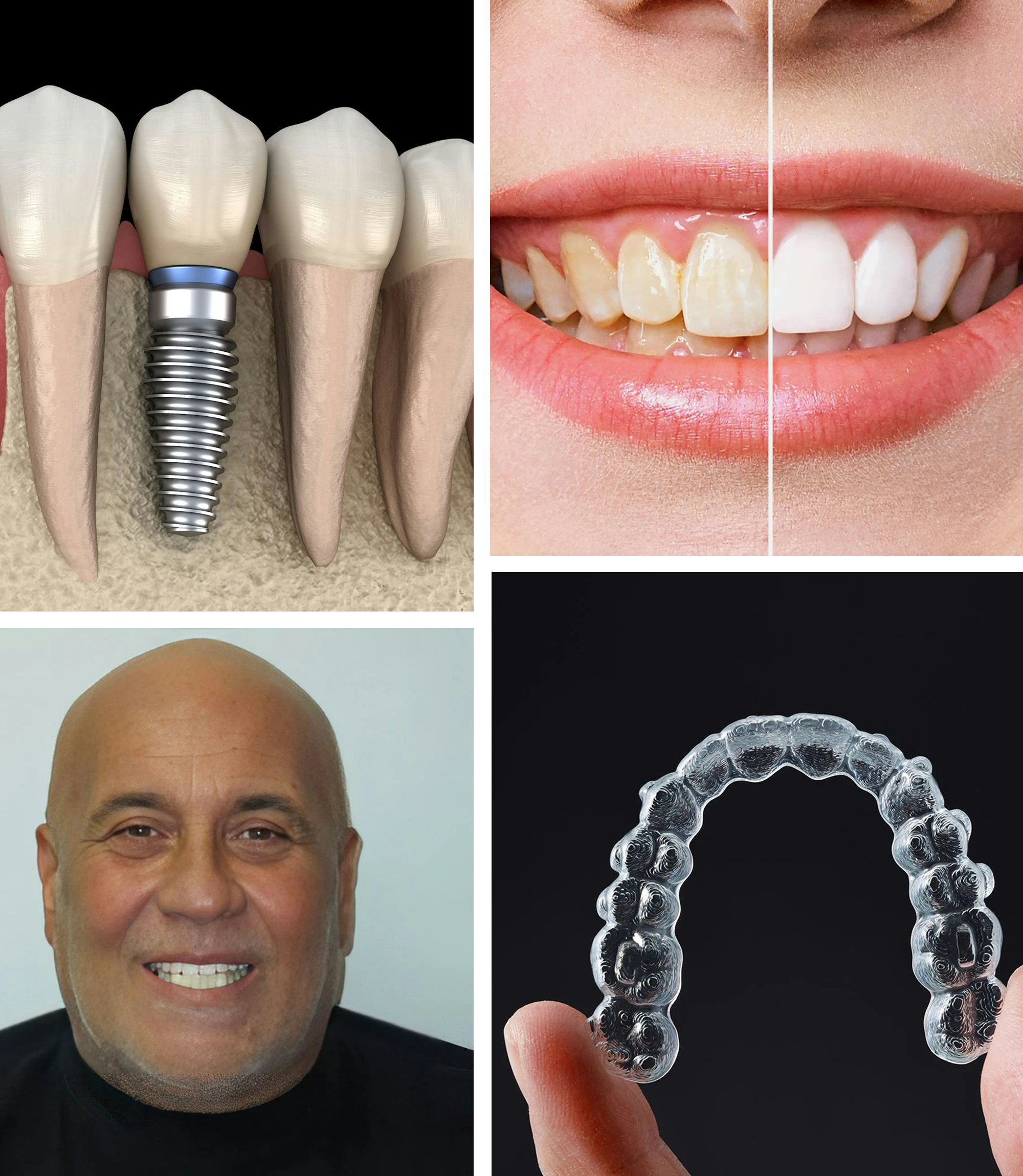 Collage showing dental implant illustration, before-and-after teeth whitening results, smiling patient with restored teeth, and a hand holding a clear aligner.