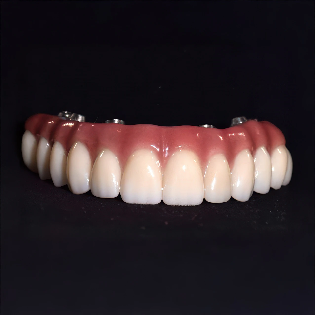 Close-up of a full upper implant-supported dental prosthesis with artificial gums and teeth.