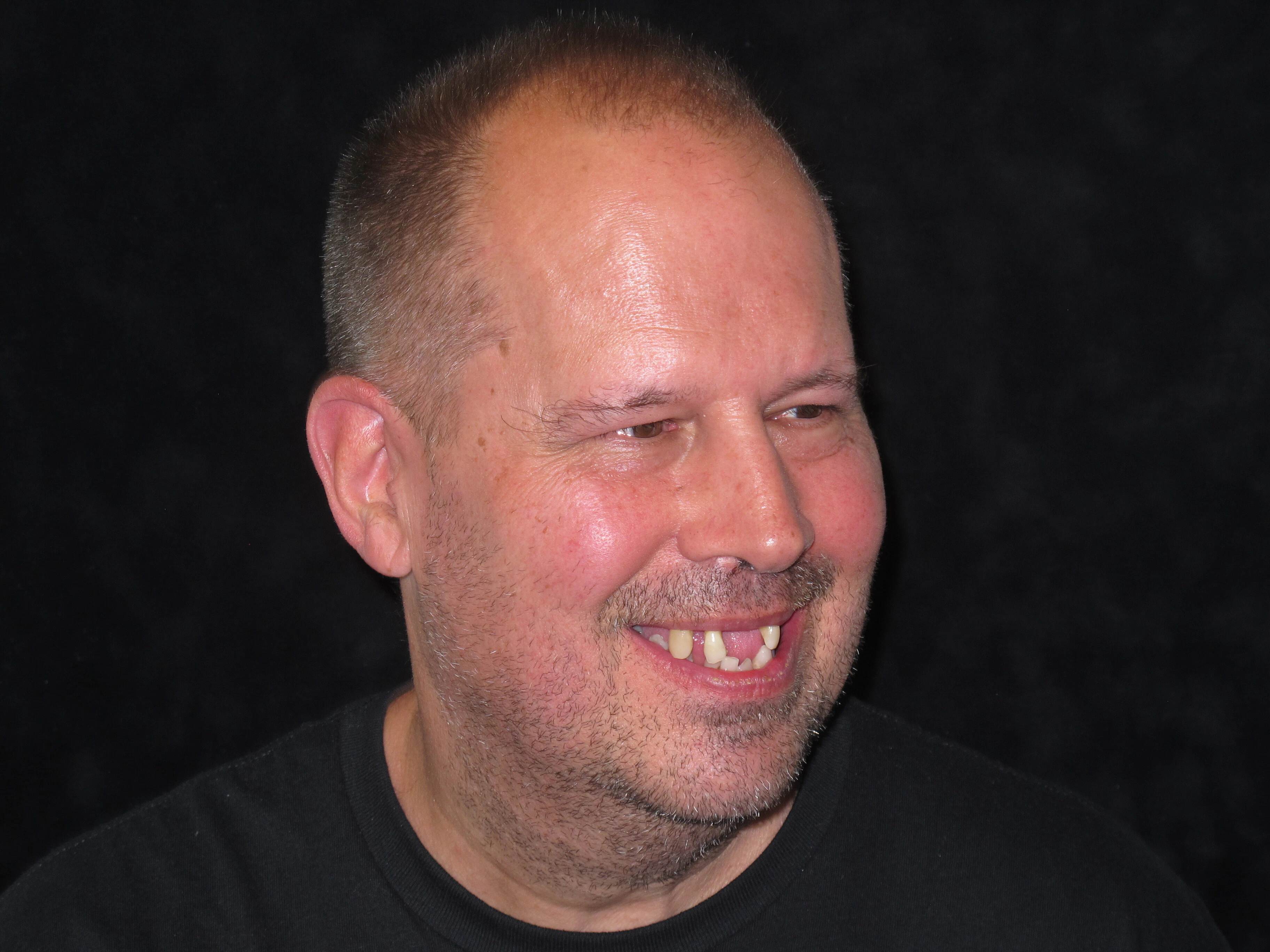 patient before dental implants
