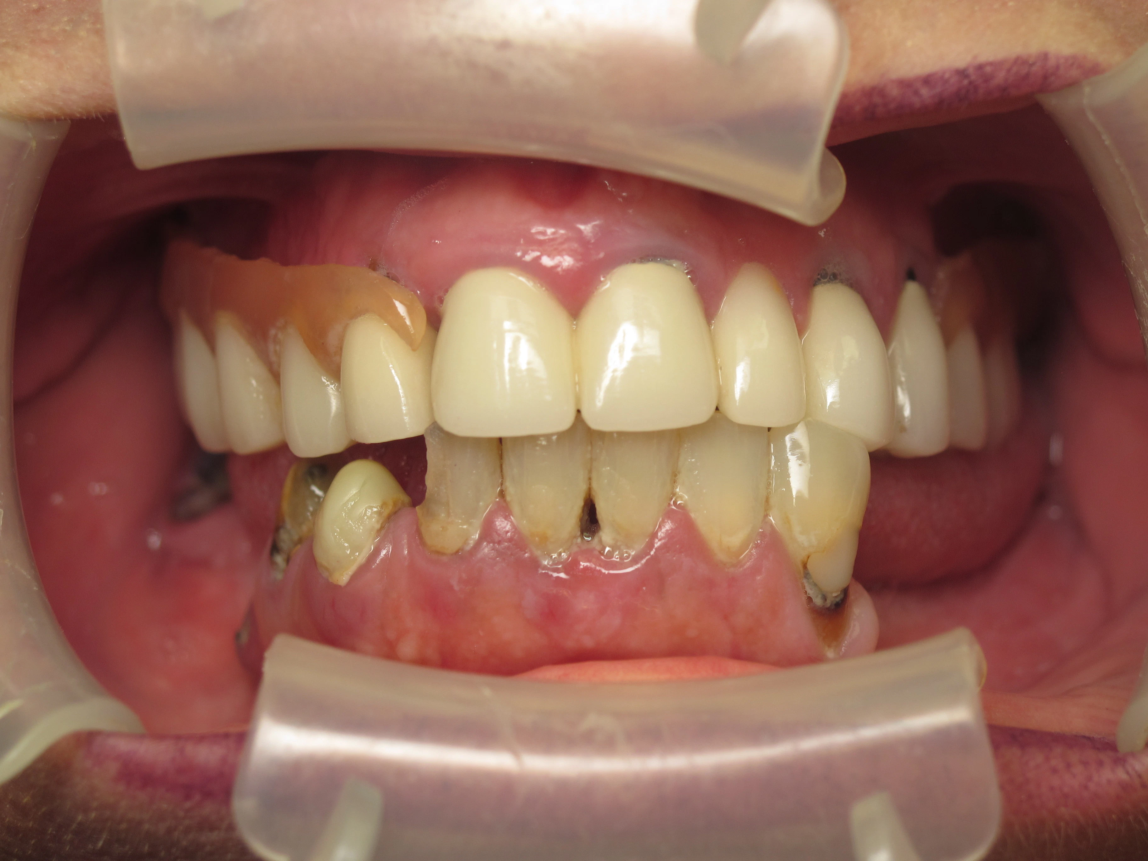patient receiving implants