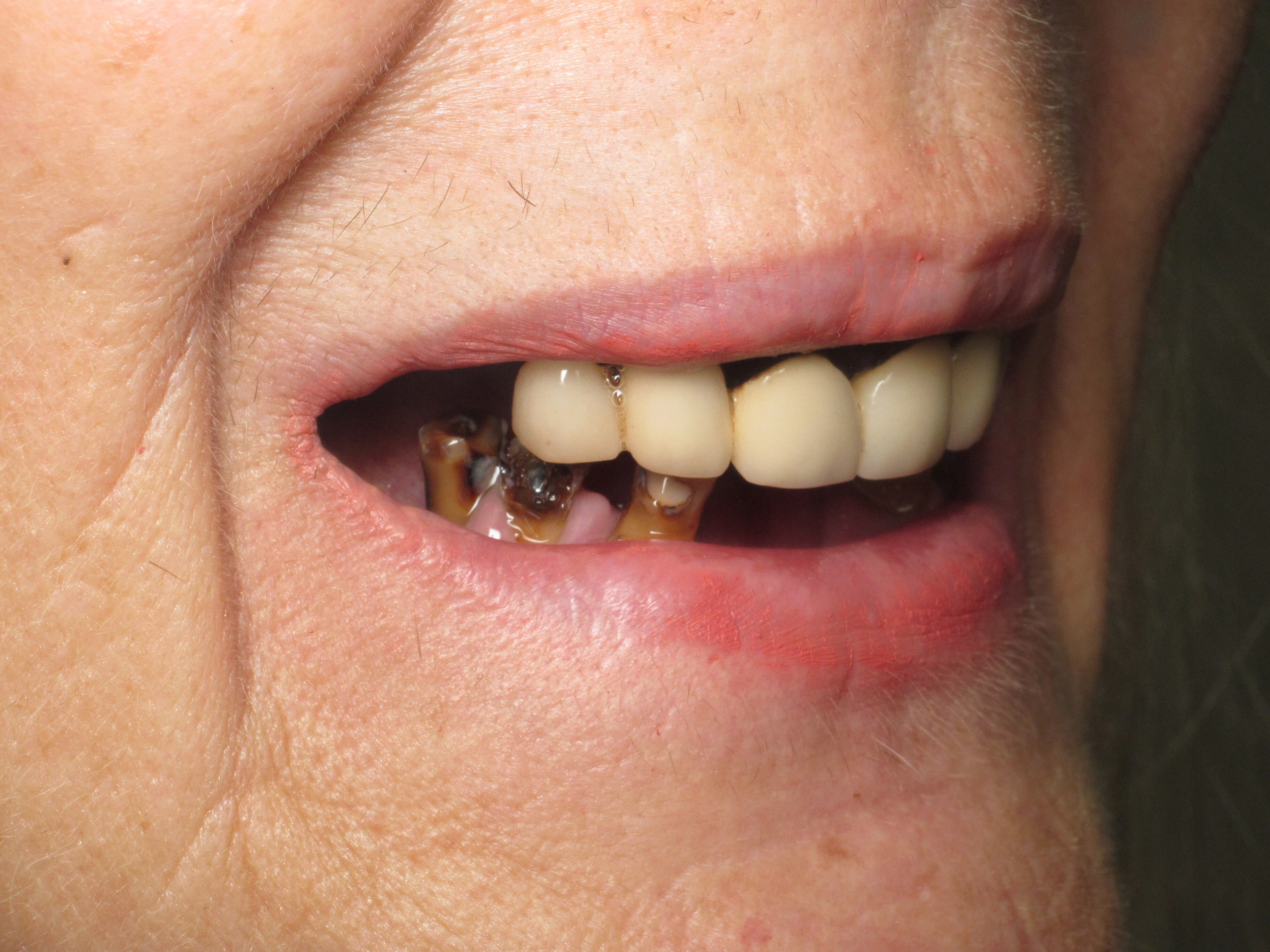 before dental implants
