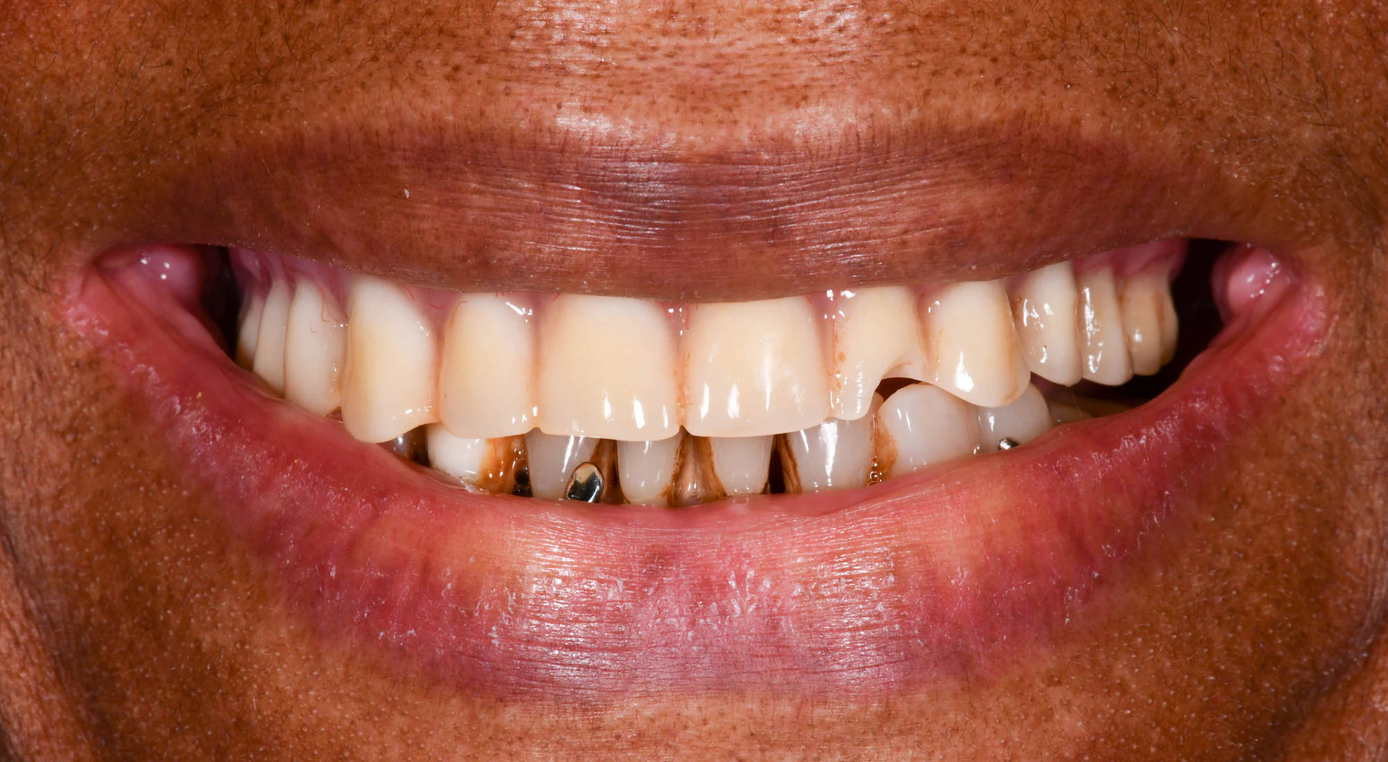 before dental work