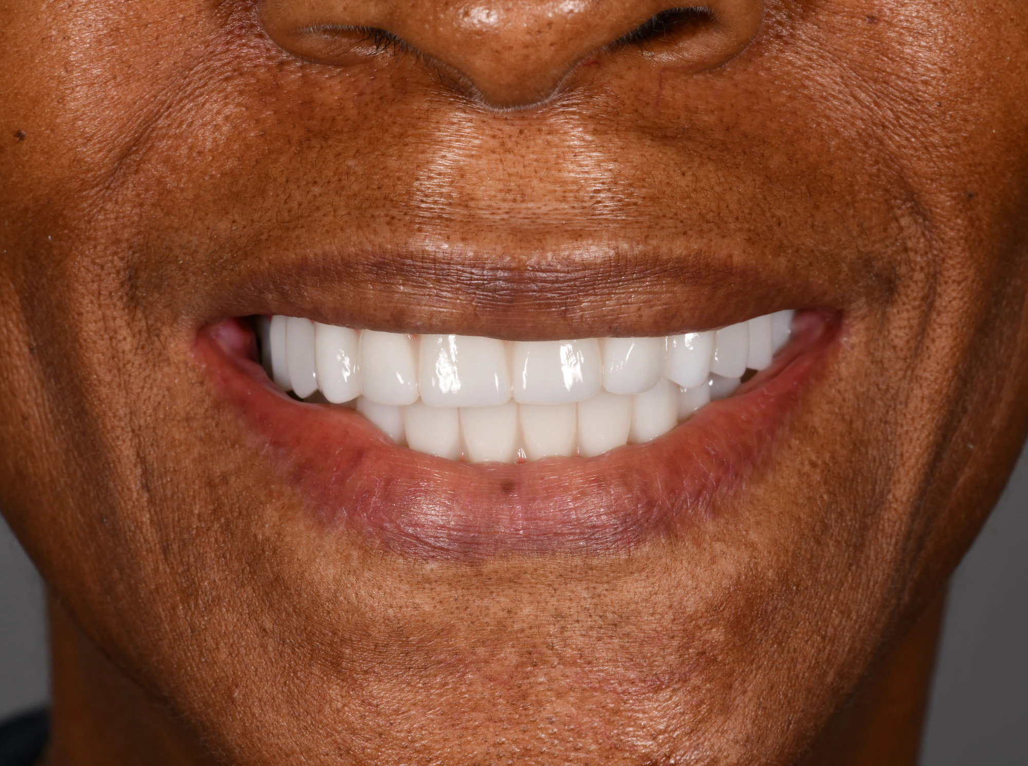 after dental work