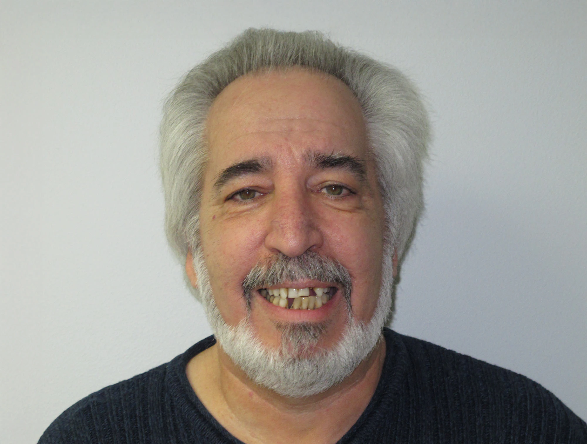 paitent midway between full mouth reconstruction