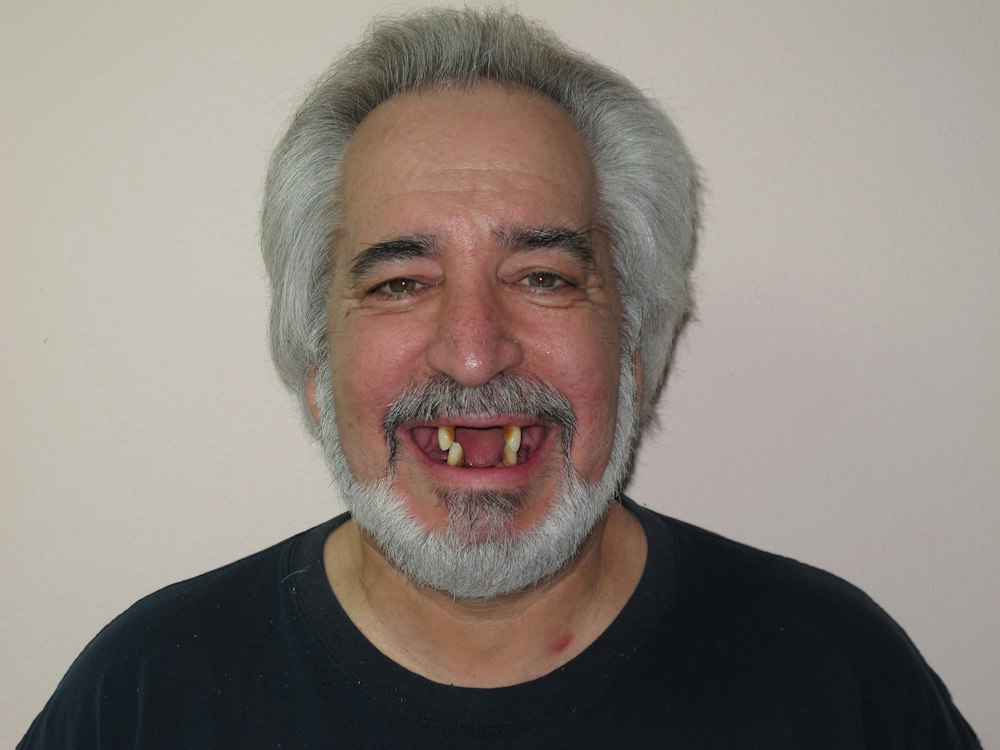 Before implant dentures