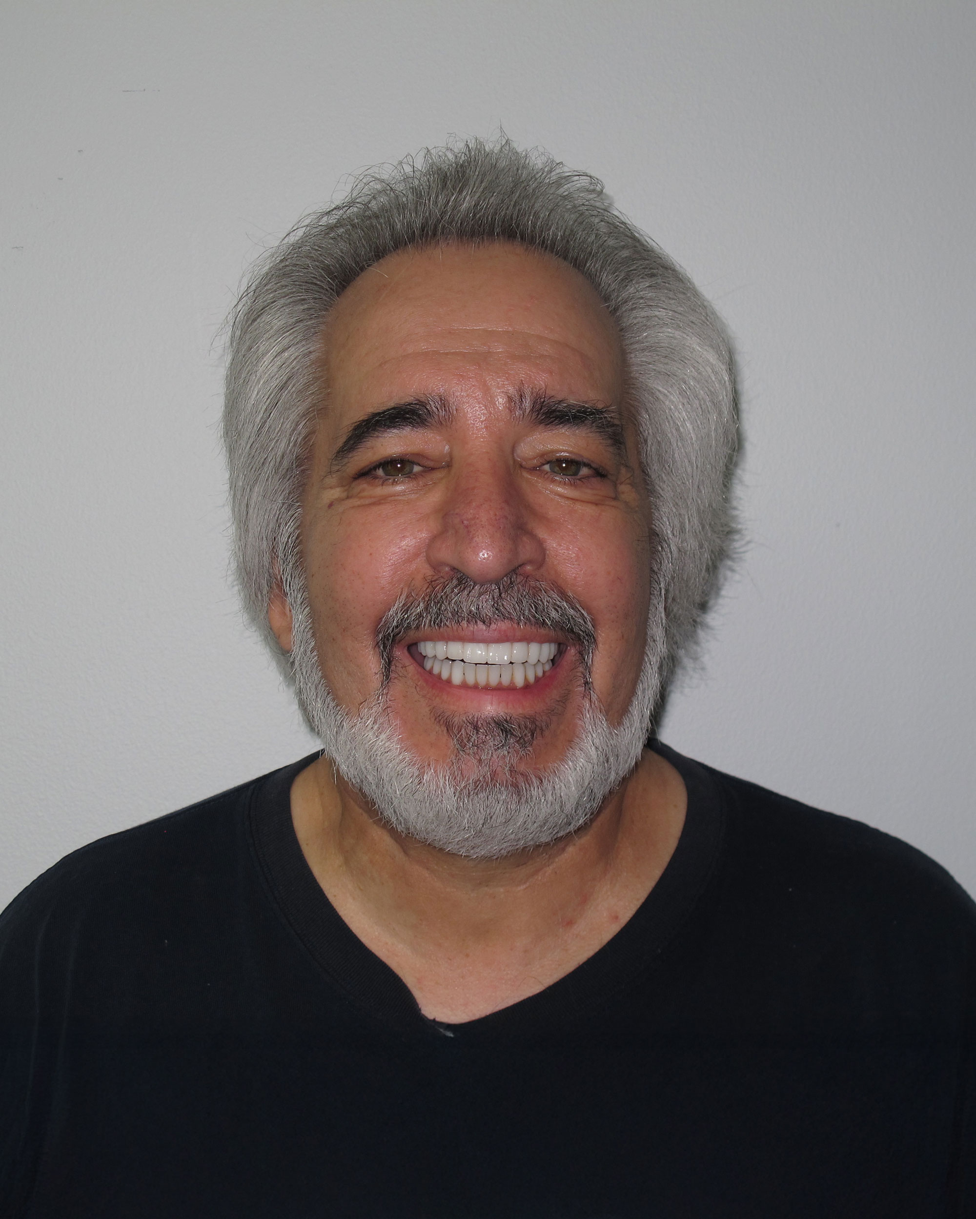 After implant dentures