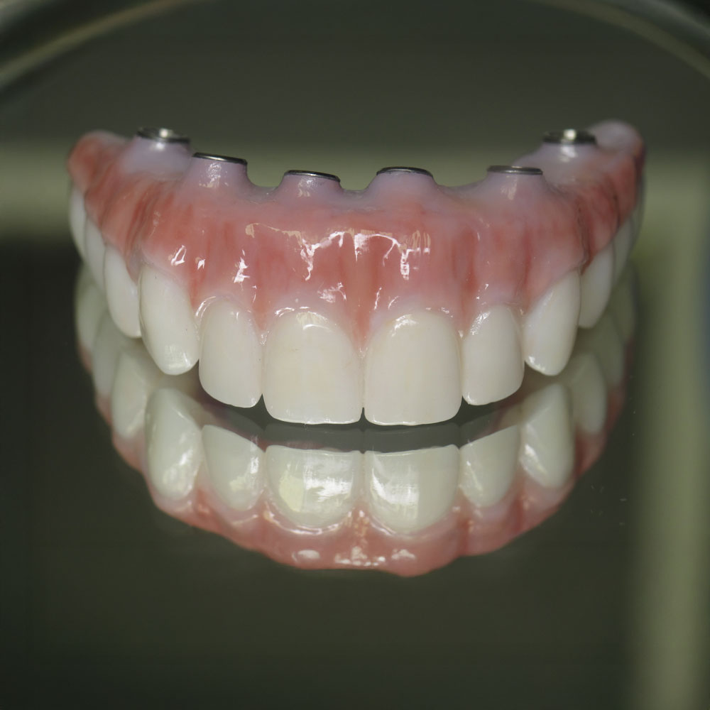 Implant dentures