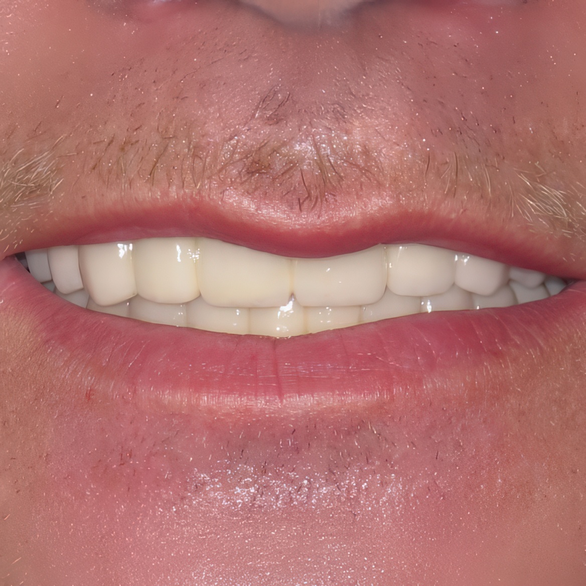 Jozef after full mouth denture implants