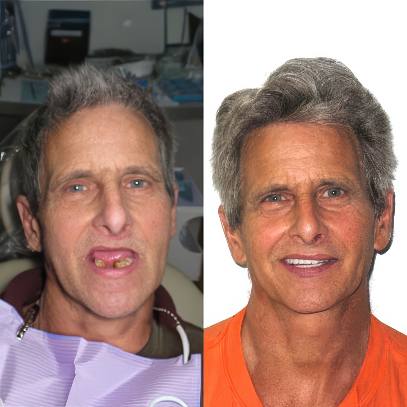 Patient before and after dentures