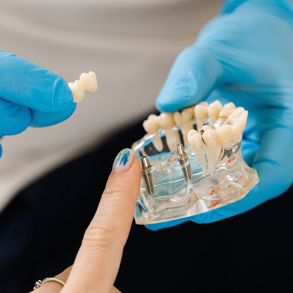 Dental Bridge