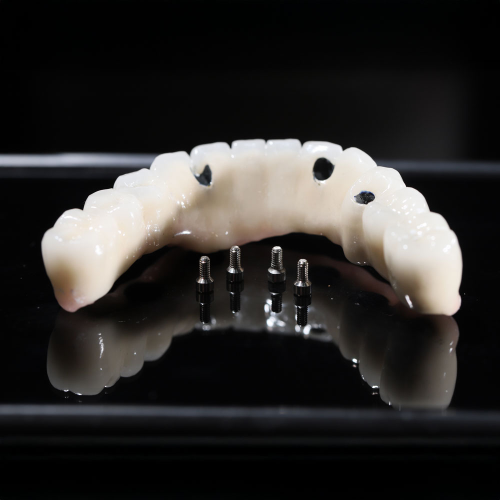 All-On-4 Implants