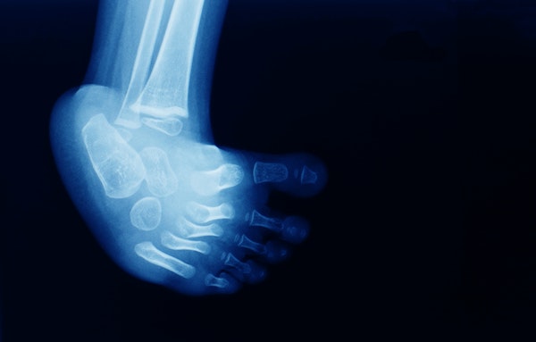 X-ray of baby foot