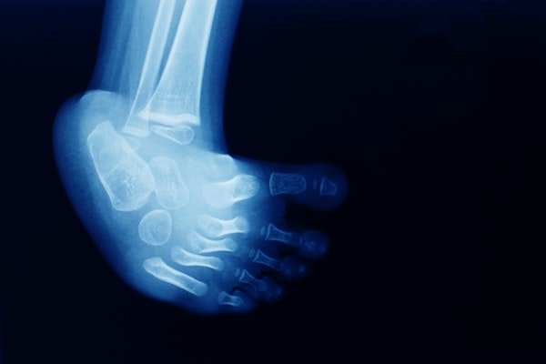 X-ray of baby foot