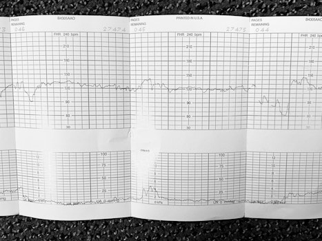image of a fetal hearth deceleration strip