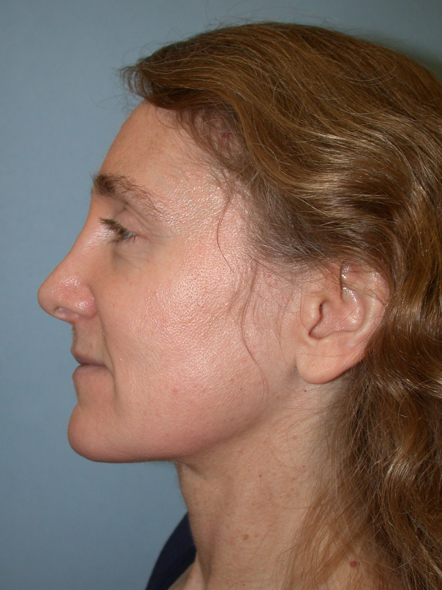 Patient after rhinoplasty