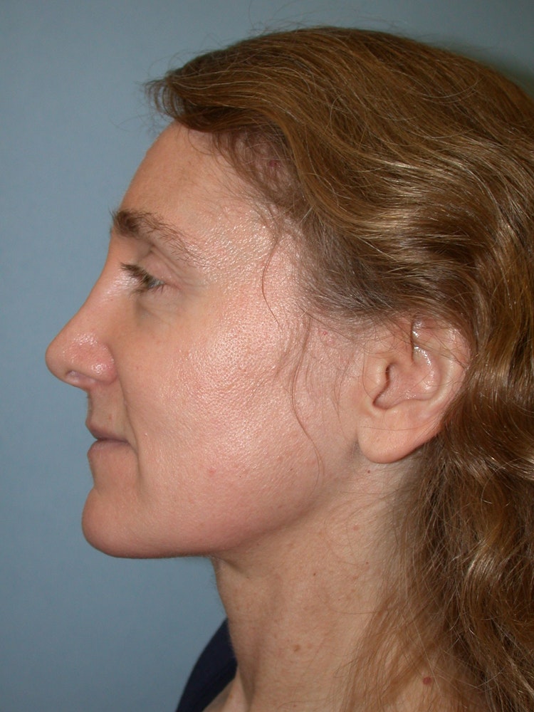 Patient after rhinoplasty