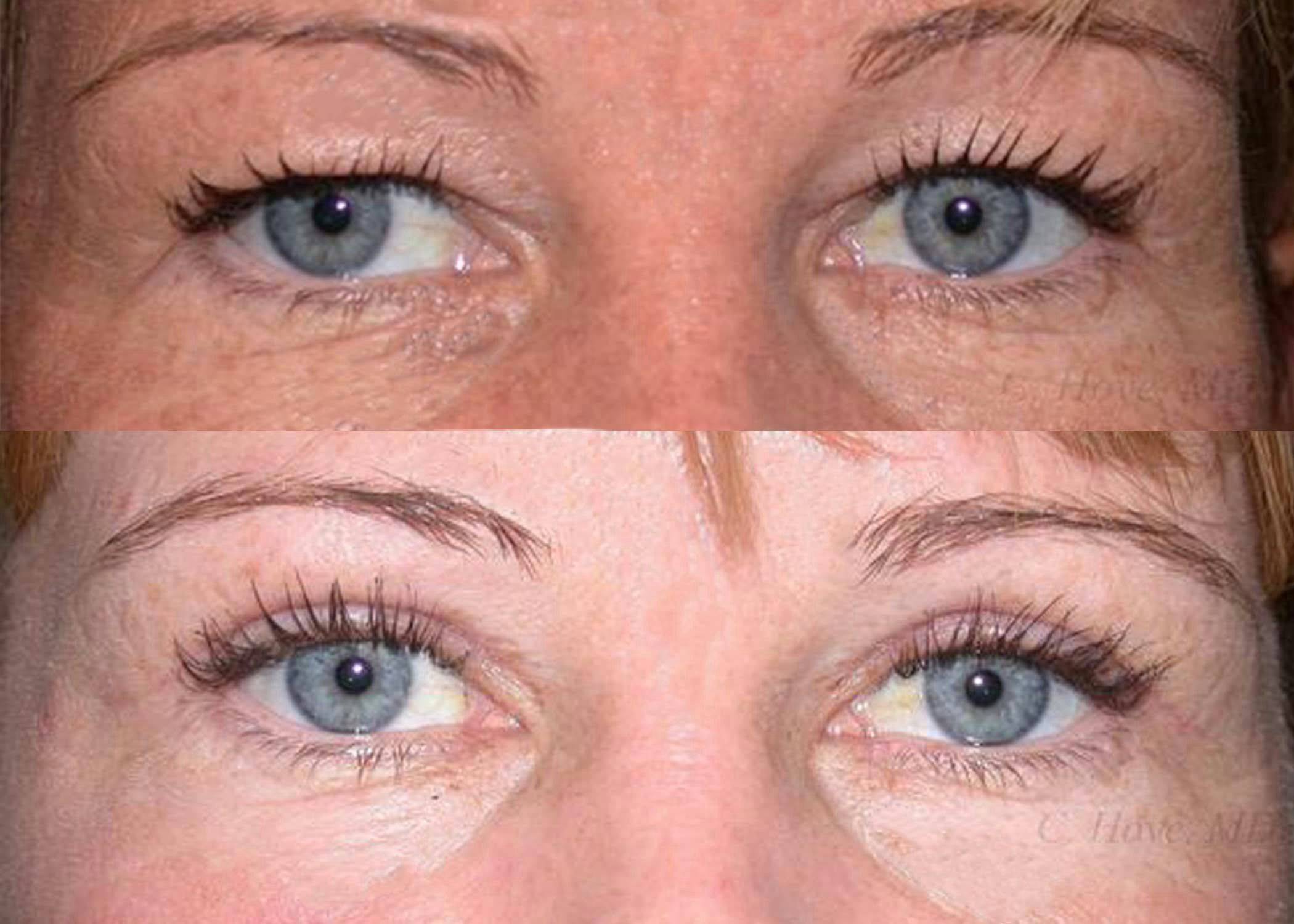 Before and after eyelid surgery