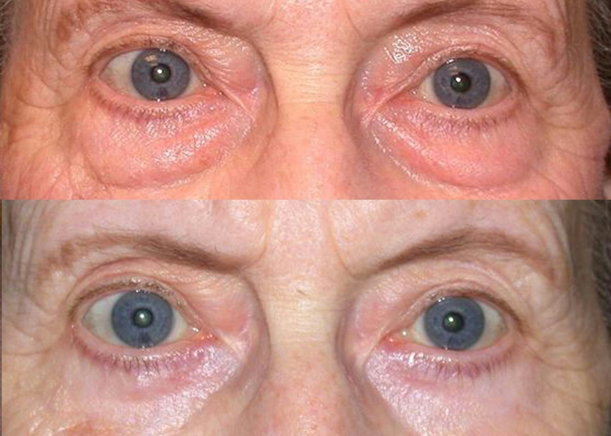 Before and after eyelid surgery