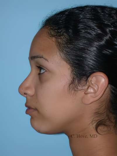 After Rhinoplasty