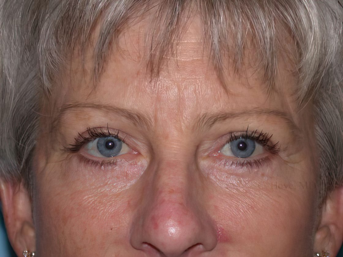 Patient after blepharoplasty procedure