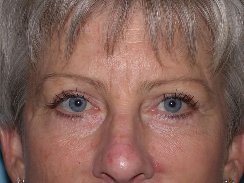 Patient after blepharoplasty procedure