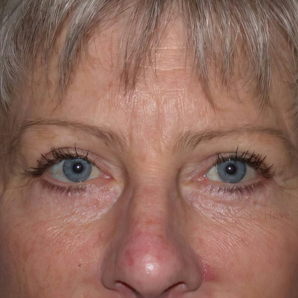 Patient after blepharoplasty procedure