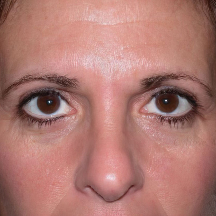 Blepharoplasty patient