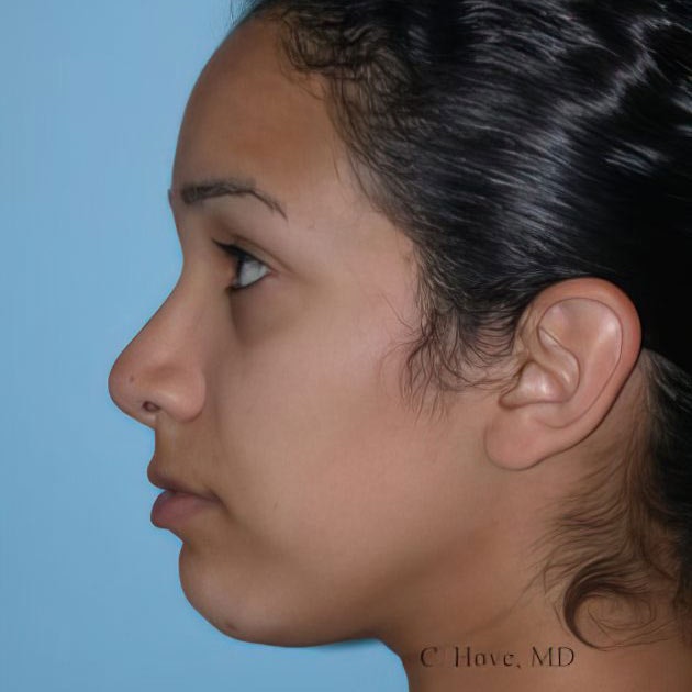 Rhinoplasty patient