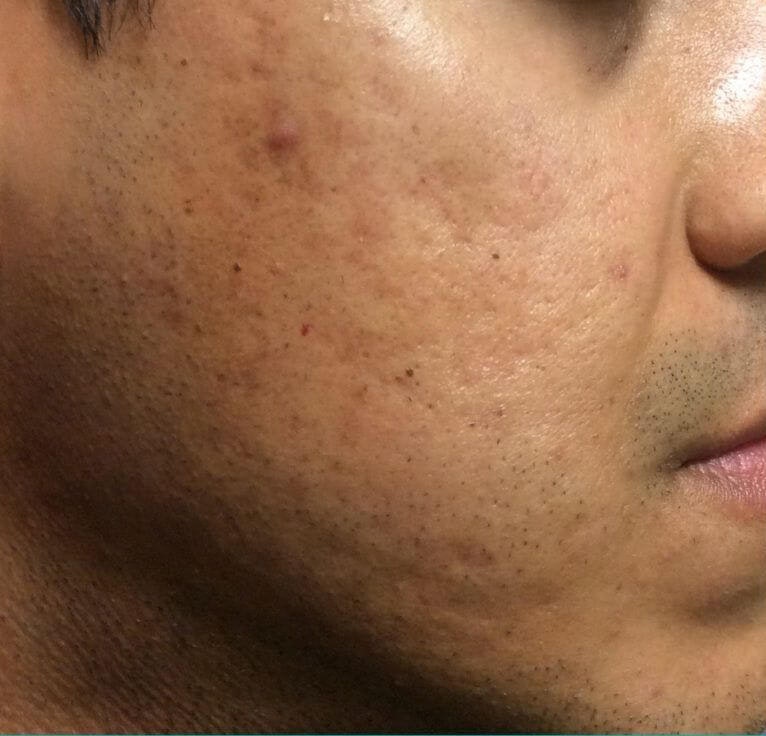 Before microneedling