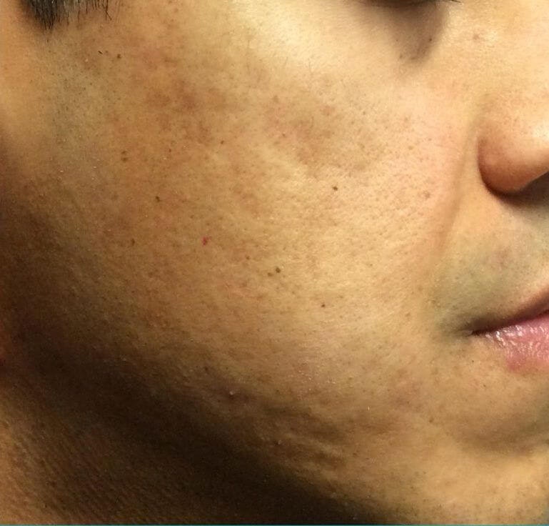After microneedling
