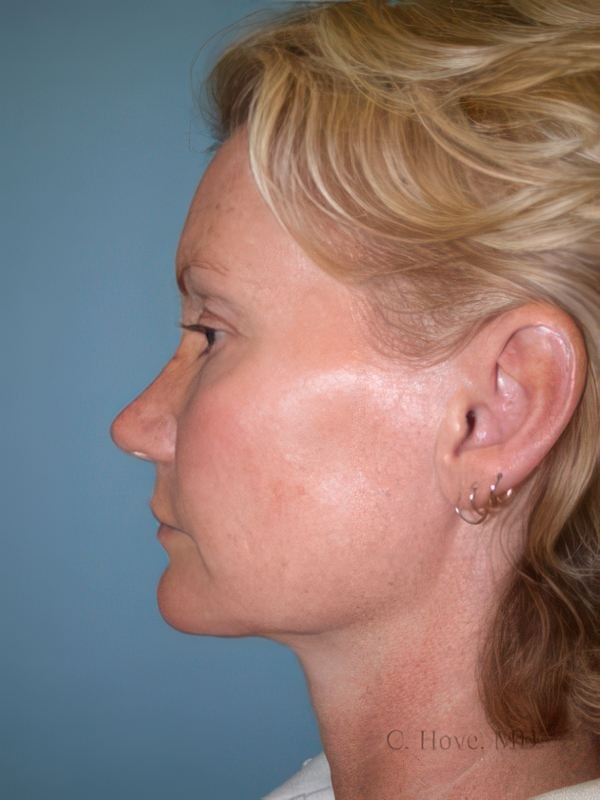 Case 1 after liposuction neck lift