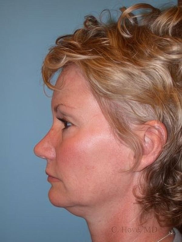 Case 1 before liposuction neck lift