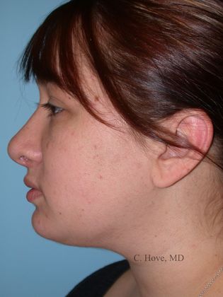 Dr. Christopher Hove's patient after chin augmentation