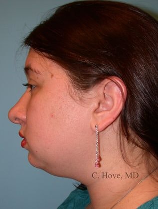 Dr. Christopher Hove's patient before chin augmentation
