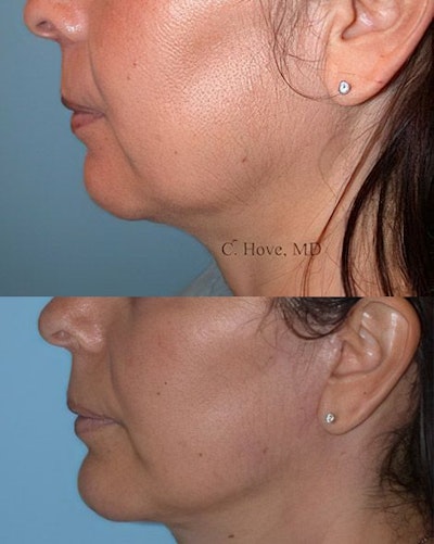 Dr. Christopher Hove's patient before and after chin implant