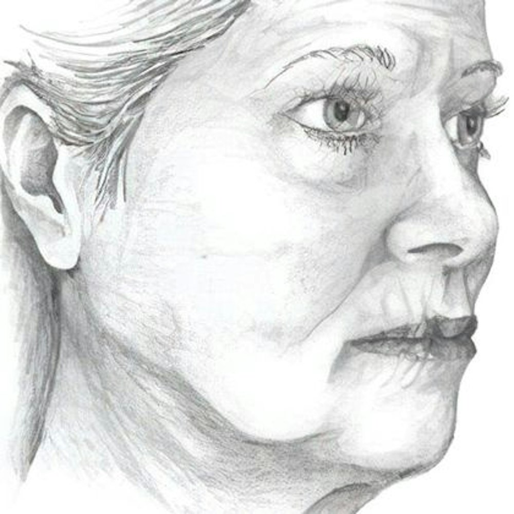 Dr. Hove's illustration of a patient's face