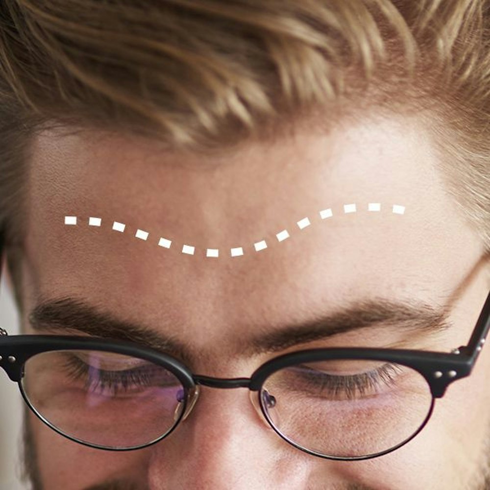 Patient's head with dotted lines in the middle of forehead