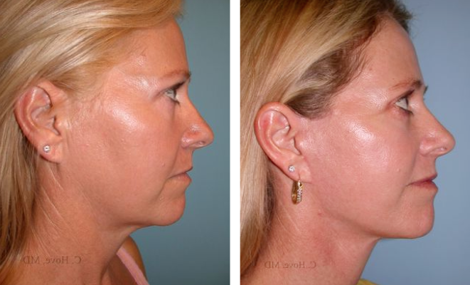 Before and after facial plastic surgery