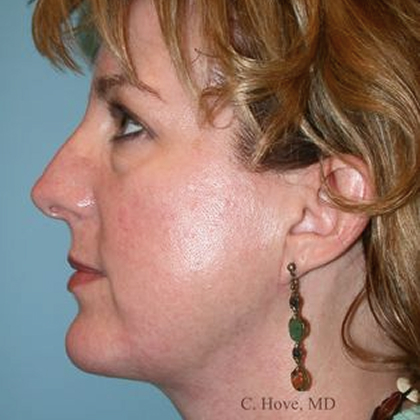 Real facelift patient