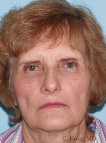 mature patient Before facelift