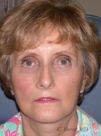 mature patient After facelift