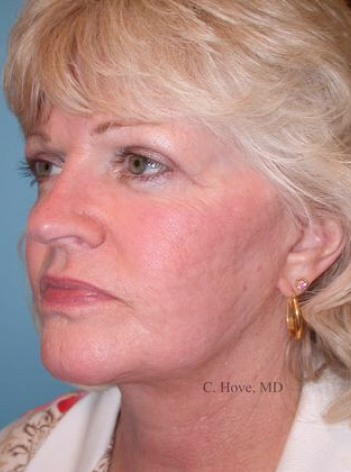 patient After facelift