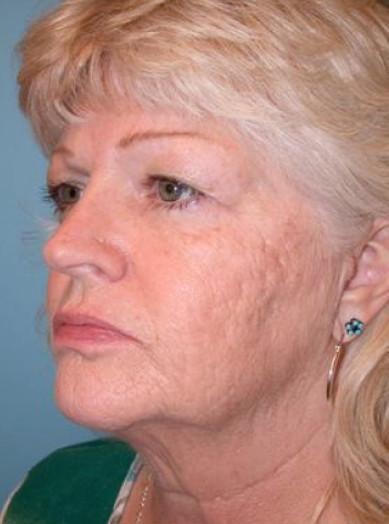 patient Before facelift