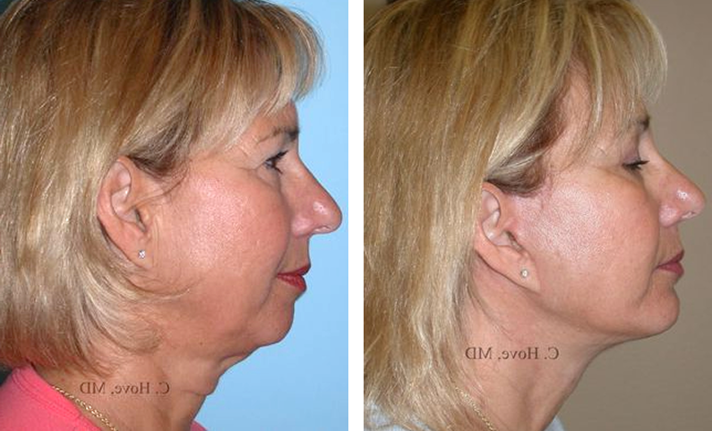 female patient before and after necklift
