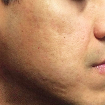 After microneedling