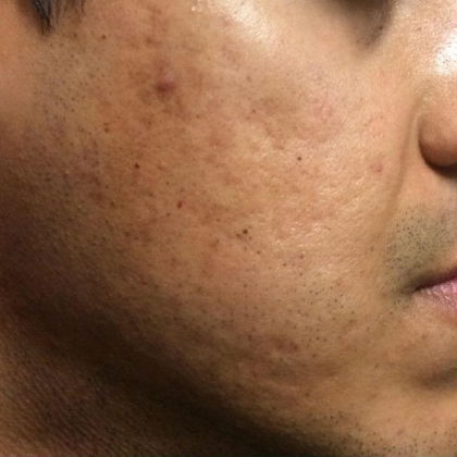 Before microneedling