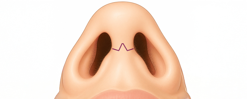 Example of a healed columellar incision from open rhinoplasty